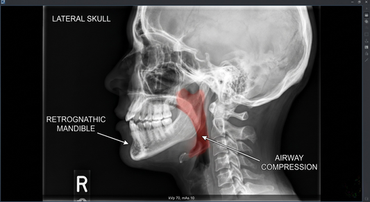 Clinical x-ray visualization showing a recessed jaw and low hyoid bone causing a structural bottleneck in the airway.