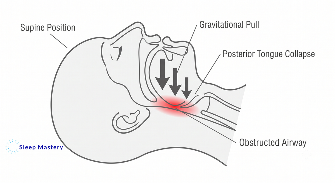 Clinical medical cross-section illustrating how gravity causes posterior tongue collapse in the supine position, leading to an obstructed airway and sleep disruption.