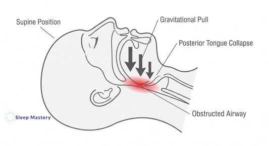 Clinical medical cross-section illustrating how gravity causes posterior tongue collapse in the supine position, leading to an obstructed airway and sleep disruption.