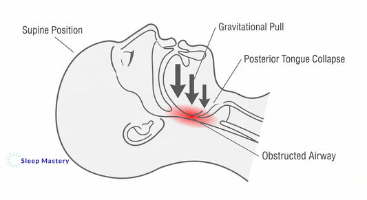 Clinical medical cross-section illustrating how gravity causes posterior tongue collapse in the supine position, leading to an obstructed airway and sleep disruption.