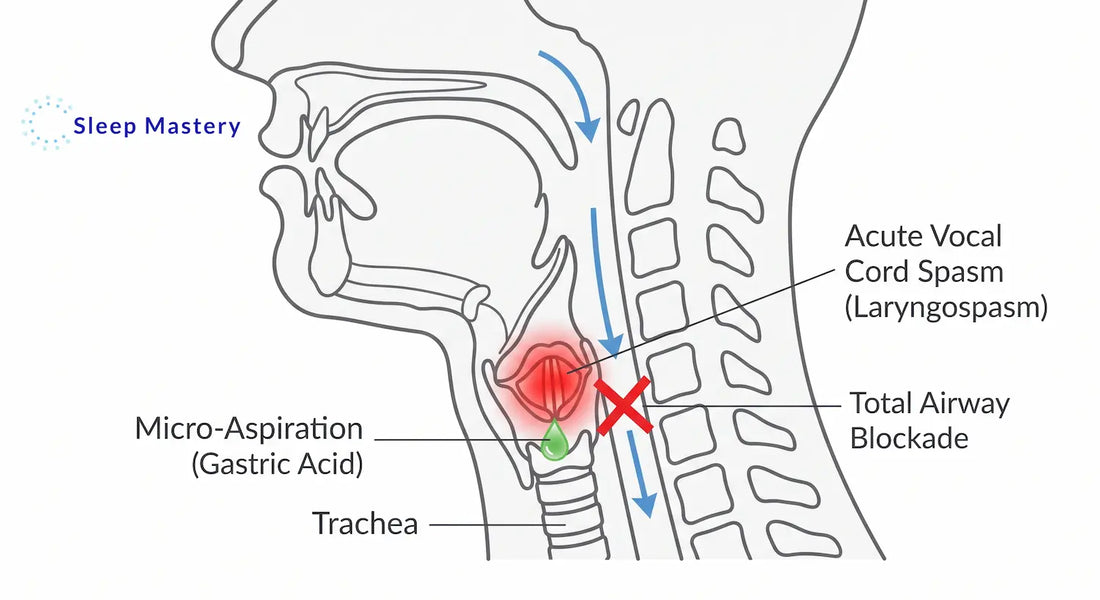 Clinical anatomical diagram illustrating a sleep laryngospasm, demonstrating how micro-aspirated acid reflux triggers an acute vocal cord spasm that completely blocks the airway and causes a waking gasping response.