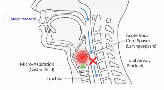 Clinical anatomical diagram illustrating a sleep laryngospasm, demonstrating how micro-aspirated acid reflux triggers an acute vocal cord spasm that completely blocks the airway and causes a waking gasping response.