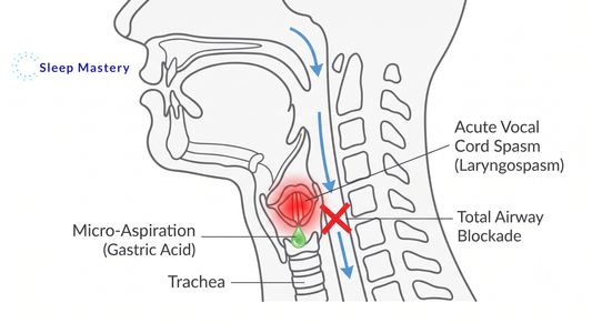 Clinical anatomical diagram illustrating a sleep laryngospasm, demonstrating how micro-aspirated acid reflux triggers an acute vocal cord spasm that completely blocks the airway and causes a waking gasping response.